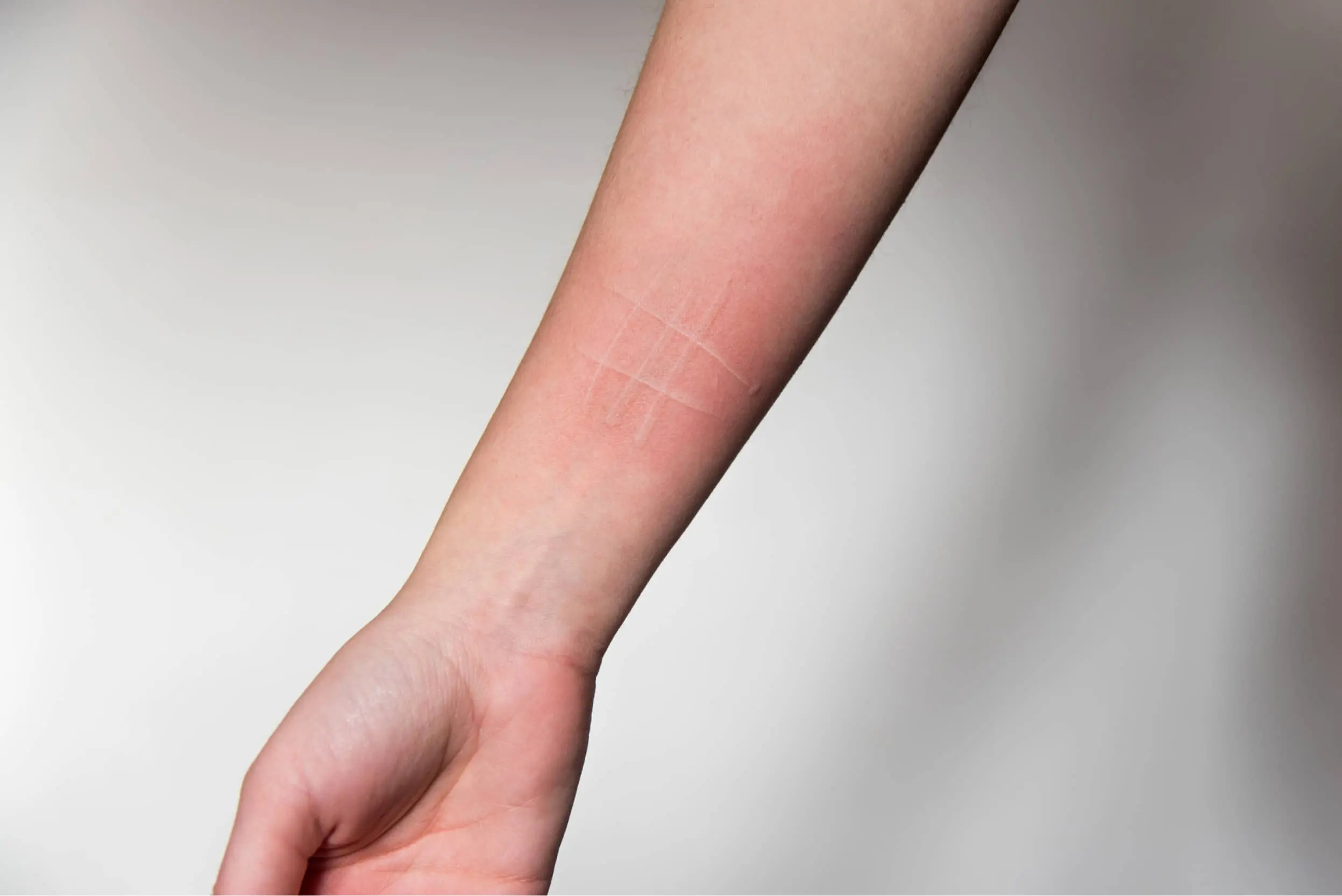 piel marcada por la ropa - Qué tipo de infecciones puede generar dermografismo